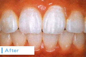 ホームホワイトニングAfter