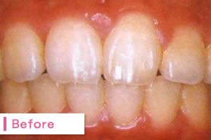 ホームホワイトニングBefore