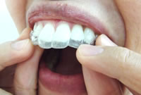 ホームホワイトニング