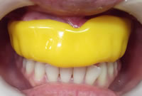 マウスピースで歯・骨・脳を守る