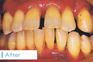 歯周病治療After
