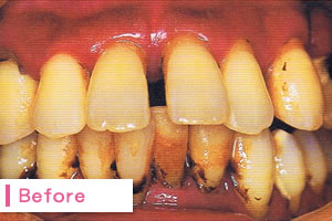 歯周病治療Before